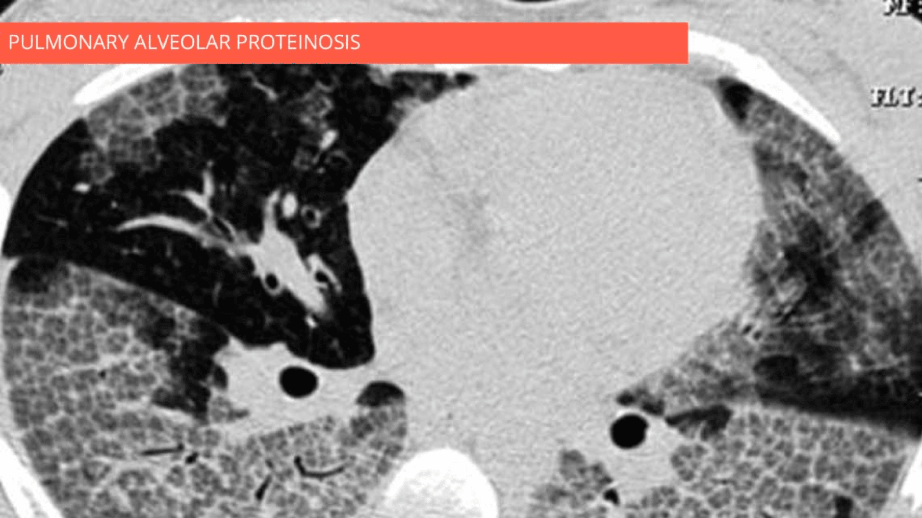 Ground-glass opacity with crazy paving pattern