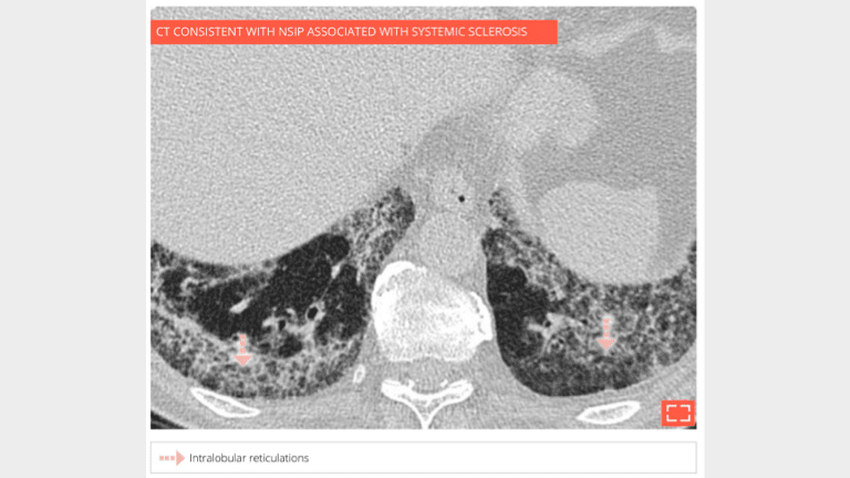 Intralobular reticulations