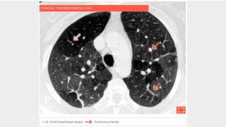  Mosaic attenuation of the lungs