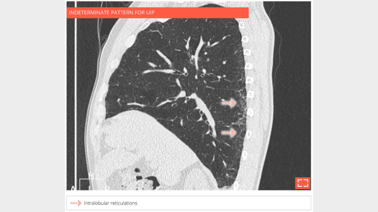 4. Intralobular reticulations