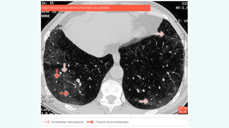 4. Ground-glass opacity associated with intralobular reticulations and traction bronchiolectasis