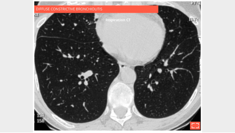 Bronchiolar mosaic attenuation