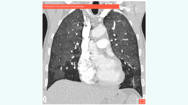 4. Ground-glass opacity associated with intralobular reticulations and traction bronchiolectasis