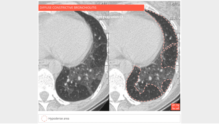 Bronchiolar mosaic attenuation