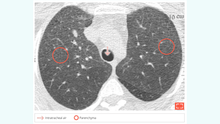 5. Ground-glass opacity with “Dark bronchus sign”
