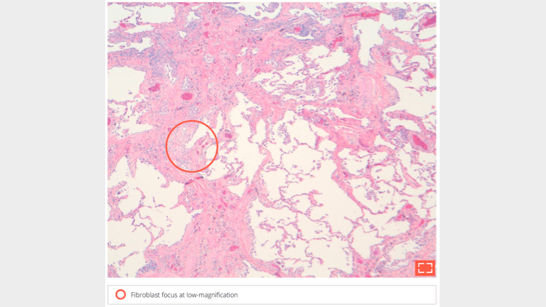 6. Paraseptal and peribronchiolar fibrosis