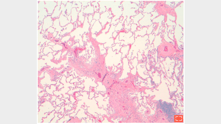 5. Paraseptal fibrosis