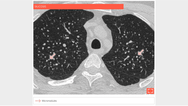 1. Traction bronchiectasis