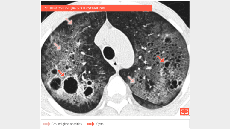 3. Cyst - ground-glass opacities