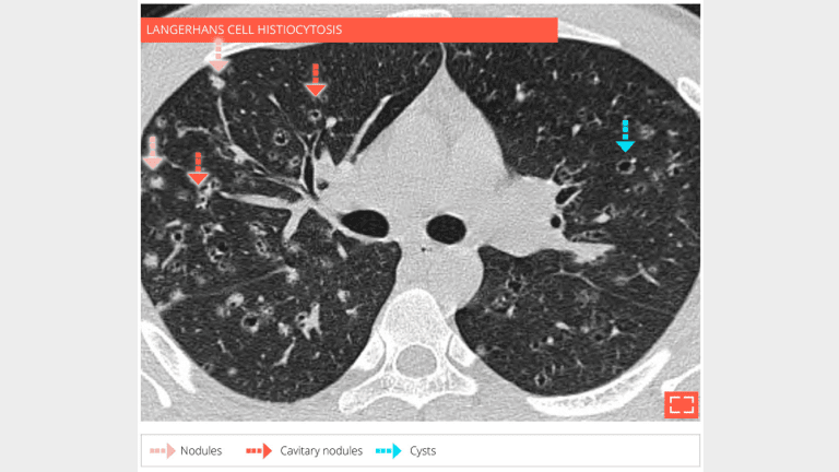 6. Cyst - nodule