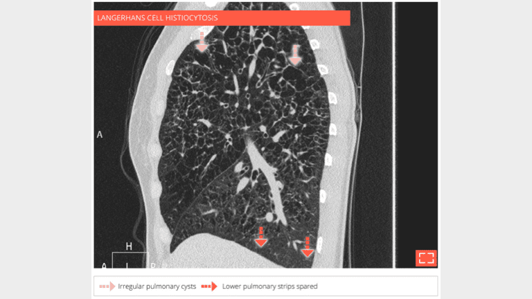 8. Cysts with "bizarre shape"