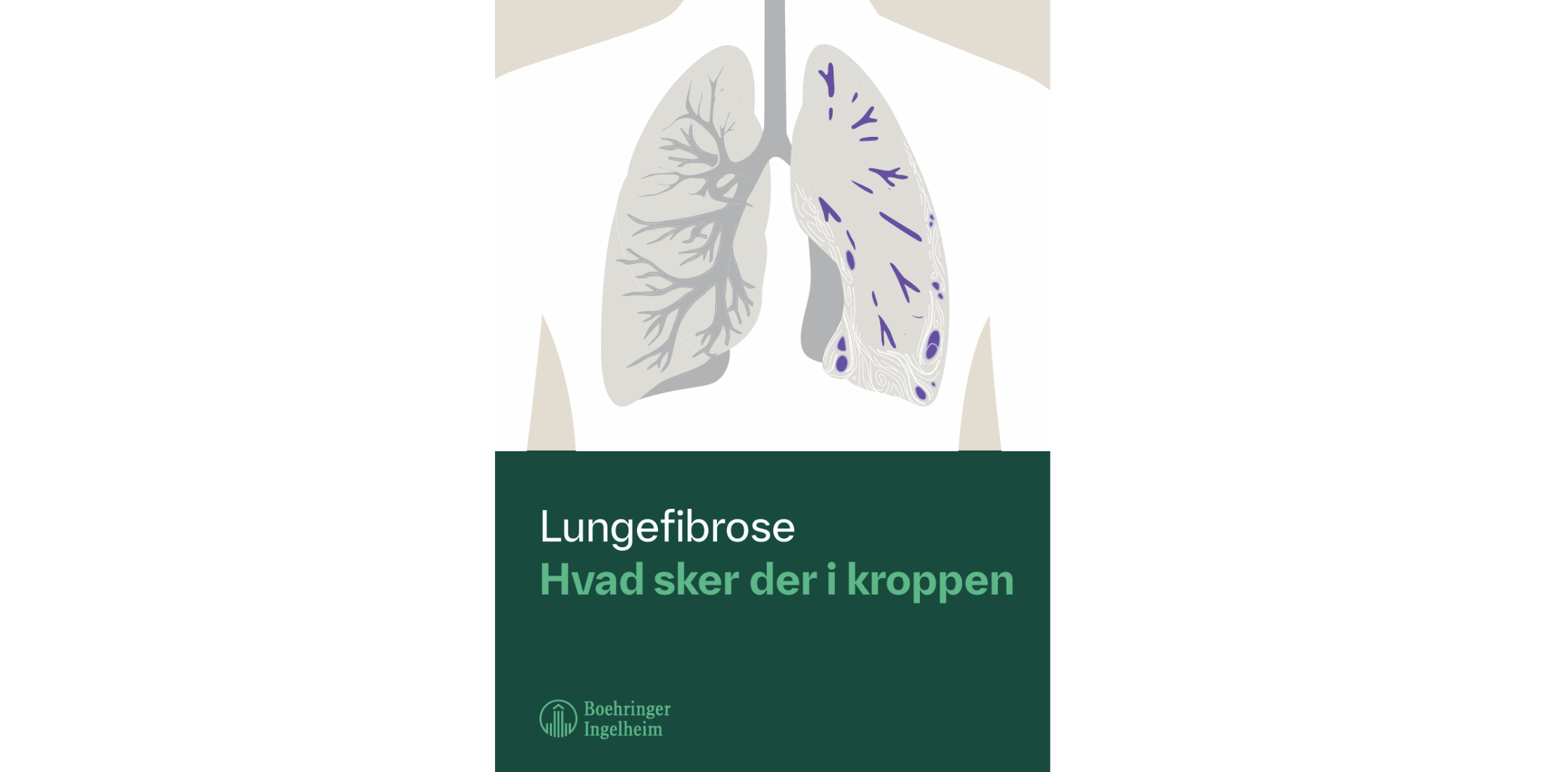 Lungefibrose - hvad sker der i kroppen?